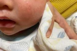 新生儿脸上红点怎么办