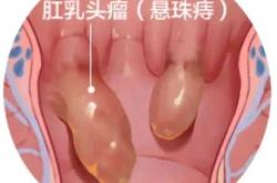 产后肛门有小肉球该咋办
