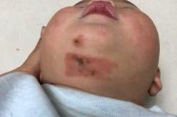 婴儿烫伤会不会留疤