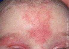 新生儿脸上有红点是怎么回事