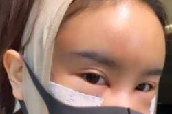 流产后为何会出现面部浮肿