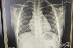 婴儿肺炎会发烧吗