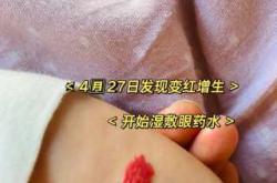 新生儿面部血管瘤怎么办