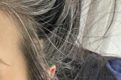 婴儿白发是什么原因