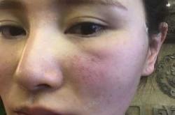 月子里烙下的病根能治好吗