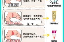 宝宝穿尿不湿总痒是怎么回事