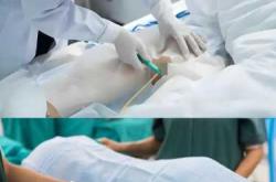 剖腹产可以打全麻吗