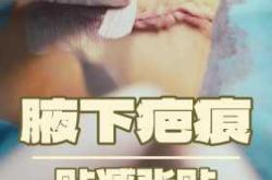 剖腹产刀疤减张贴有用吗