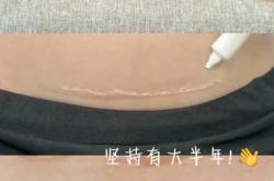 剖腹产术后没有尿意怎么办