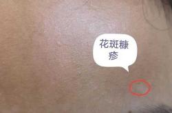 新生儿脸上有白斑怎么办