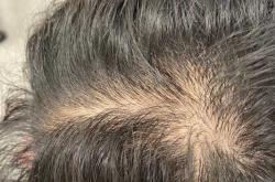 为何产后掉发严重