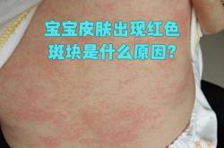 新生儿湿疹有什么症状表现