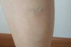 剖腹产右腿酸是什么原因