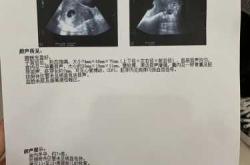 孕十周孕反好转正常吗