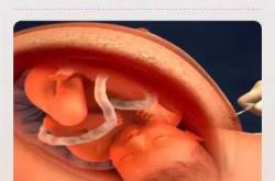 剖腹产为啥一直哭