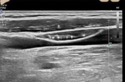 甲状腺b超对备孕有影响吗