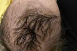 婴儿头皮青怎么回事