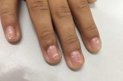 婴儿指甲发白怎么回事