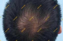 男士备孕可植发吗