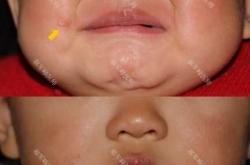 新生儿先天性皮脂腺痣是啥