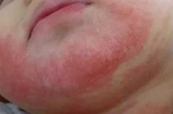 焦婴儿的原因是什么