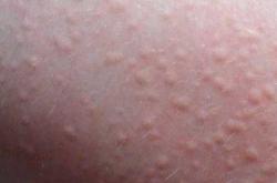 女性荨麻疹还能备孕吗