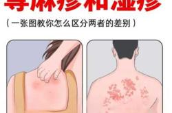 剖腹产与湿疹有什么关系吗