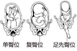 臀位剖腹产最佳时间是什么时候