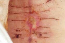 剖腹产孩子腹围有啥影响吗