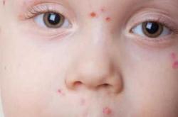 新生儿会传染水痘吗