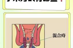 有外痔疮可以顺产吗
