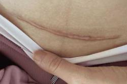 剖腹产刀口长度是多少呢