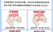 新生儿屁屁红怎么办
