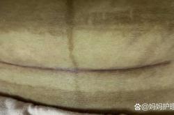 梦见别人剖腹产啥寓意呢