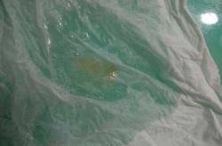 怀孕肚子能不能吸回去