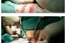 剖腹产刀口夹子怎么用