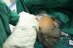 眉山剖腹产情况如何