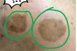 流产后脸上长斑有图片吗