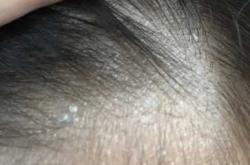 婴儿头皮出现白斑怎么回事