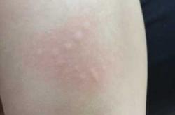 坐月子受风起疙瘩有图吗