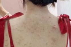 流产后身上起红疙瘩是怎么回事