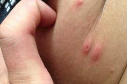 产后风疹有啥症状图片