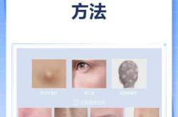 产后有囊肿该怎么办