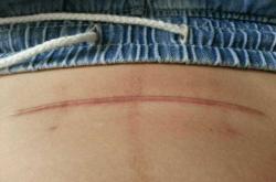 剖腹产怎么拆线