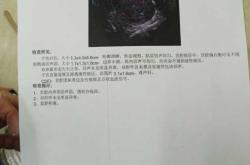 引产后有血块排不出来怎么办