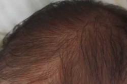 婴儿脸上有白块是怎么回事