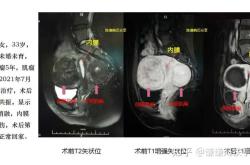 腰疼做核磁共振影响备孕吗