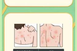 产后身体痒是怎么回事