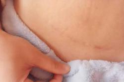 疤痕厚度多少可顺产