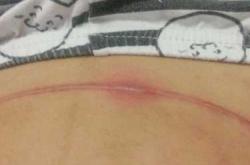 剖腹产14天伤口为何还疼